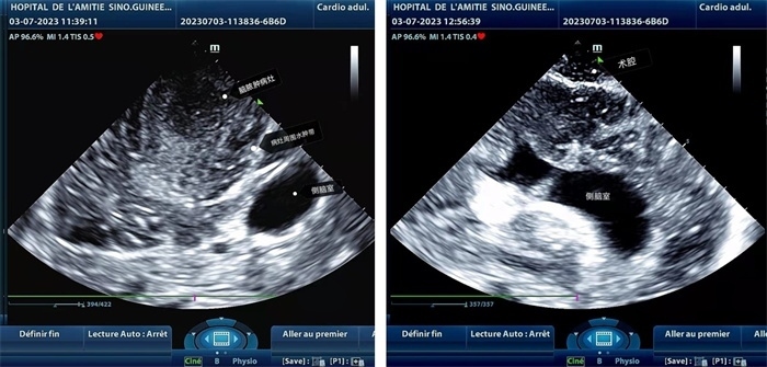 左圖顯示術(shù)中超聲見囊實(shí)性病變，大小約為4x4x3cm，病灶周圍腦組織水腫明顯；右圖為病灶切除后，術(shù)中超聲示術(shù)腔無病變殘留