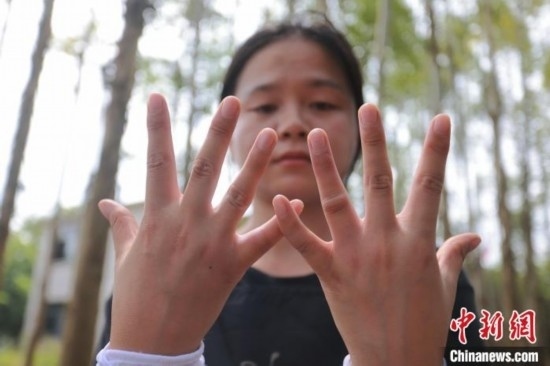 吳素英展示被蜜蜂蜇過(guò)的雙手。湯曉逵 攝