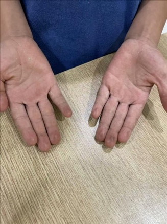 9歲小學生長期拍煙卡，手部粗糙長繭。受訪者供圖